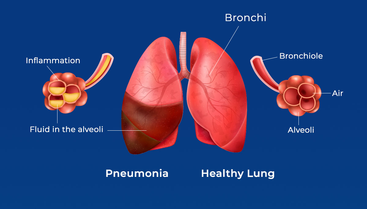 Top Killer Disease: Pneumonia - Promotion And Campaign